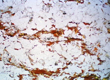 biotite-cordierite gneiss